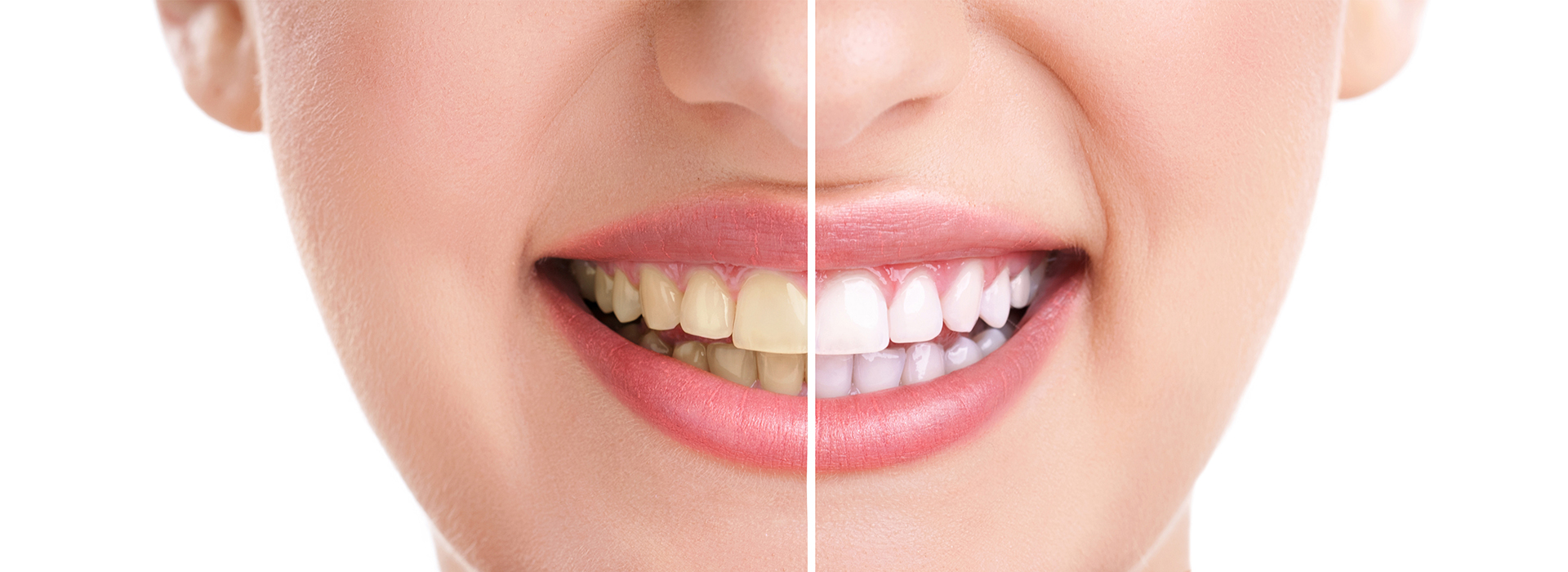 The image is a close-up of a person s face, showcasing their teeth before and after a dental procedure, with the  before  side on the left and the  after  side on the right.